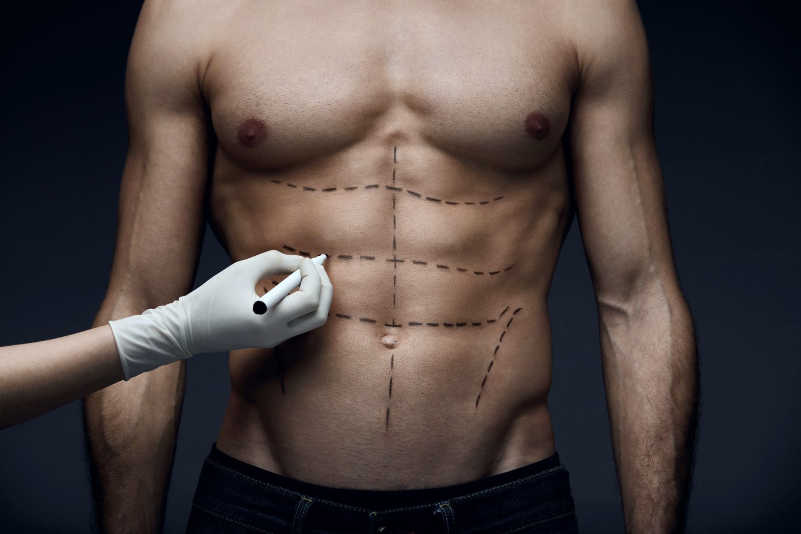 7. Abdominoplastie