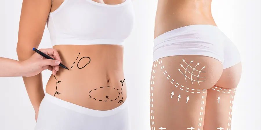 1686478687_bbl-and-tummy-tuck